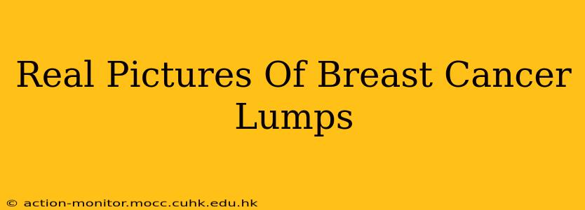 Real Pictures Of Breast Cancer Lumps