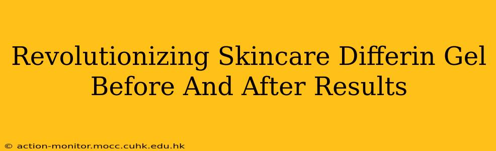 Revolutionizing Skincare Differin Gel Before And After Results